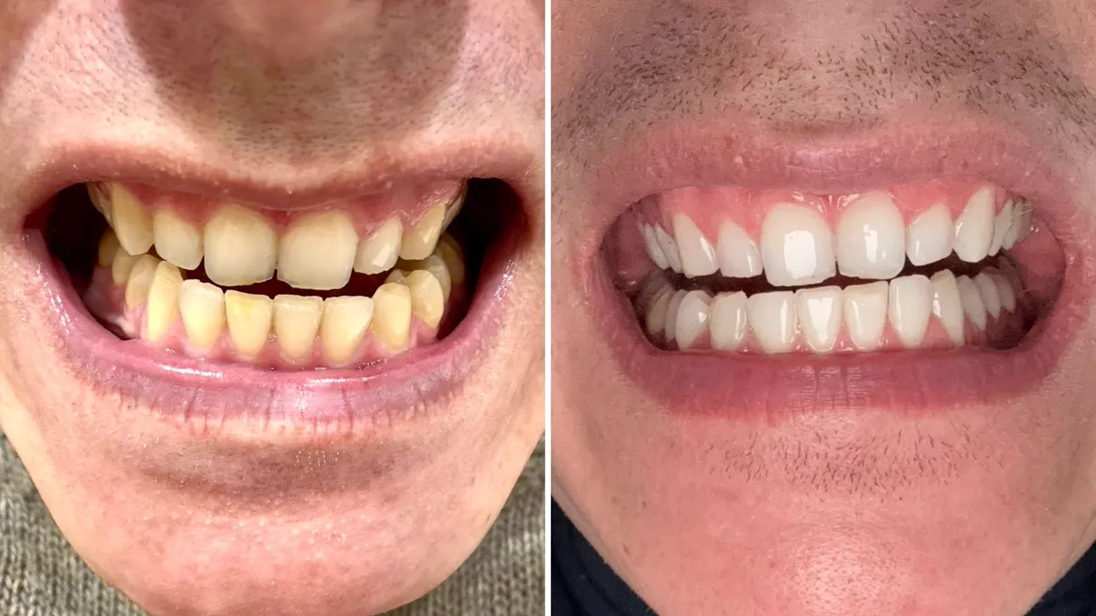 Before and after – Professional whitening