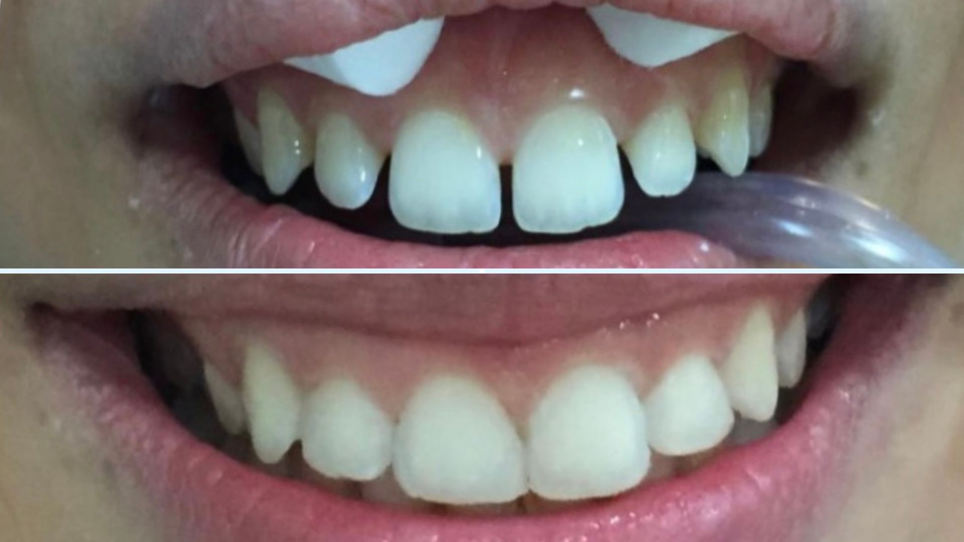 Before and after – Composite veneers