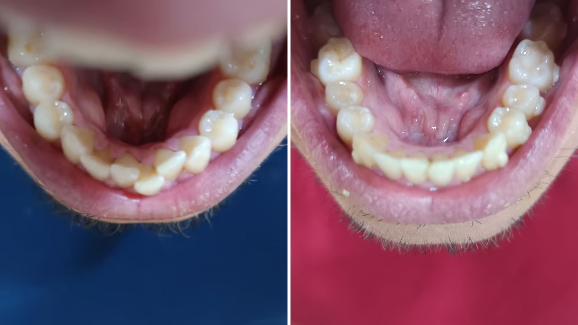 Before and after – Clear aligners – Severe crowding